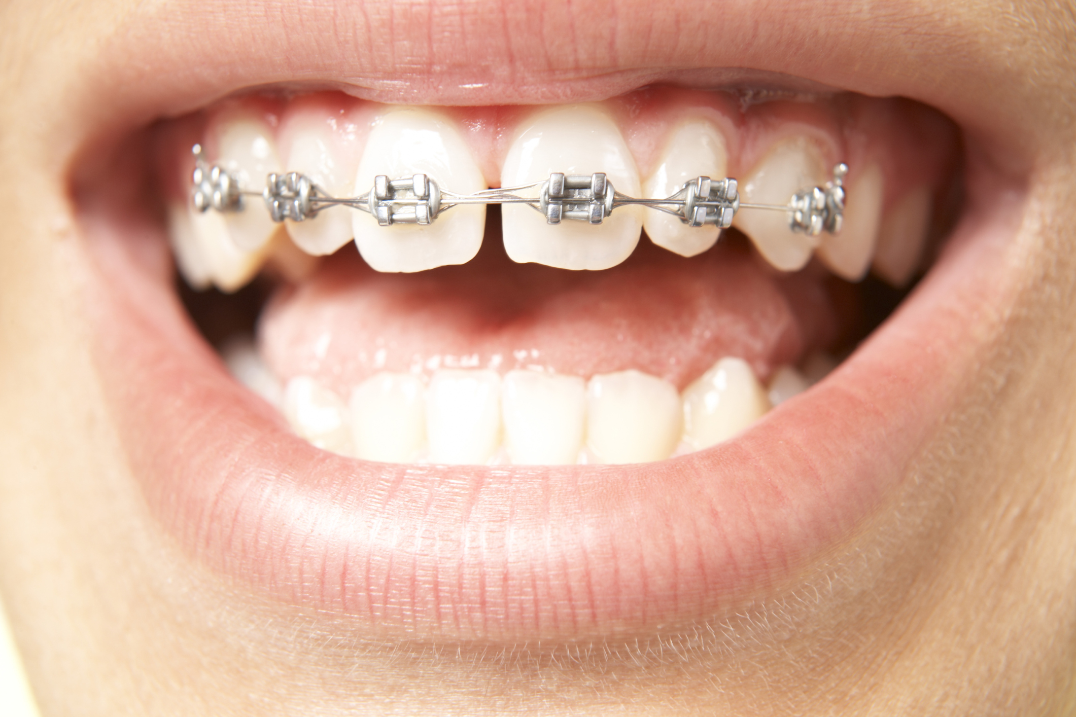 orthodontics canberra