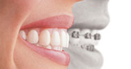 Which is better:  Braces or Invisalign?