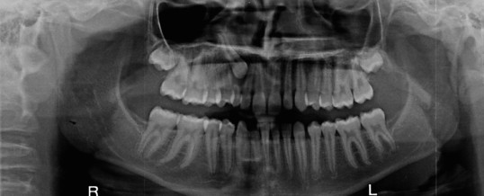 The Use of X-rays in Orthodontics