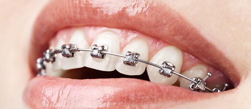 How to Avoid Delays in your Orthodontic Treatment