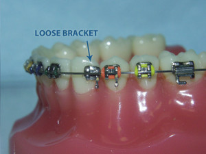 loose-bracket (3)